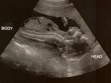 ultrasound